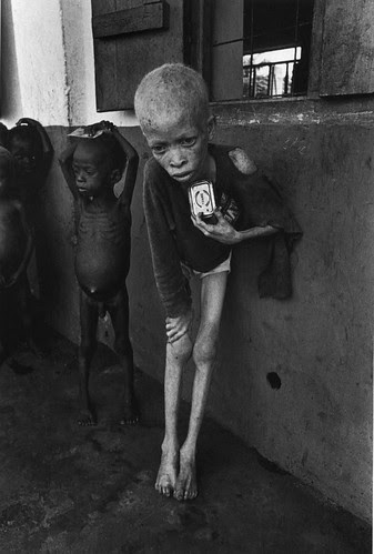 A starving albino boy, harassed and discriminated against for the color of his skin, clutches an empty corned-beef tin at an orphanage, Biafra 1969, by Don McCullin