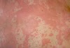 Skin Cancer Itchy Spot - Red spots on scalp: Pictures, causes, and treatments / Discovering new growths on your skin can cause your mind to race towards worrying about cancer, but take heart.