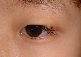 霰粒腫 さんりゅうしゅ の治療と患者さんの体験談 眼科医大高功