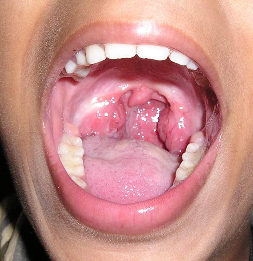 saint tattoo knoxville: ulcer on tonsil