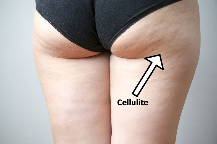 Best natural remedies and foods to fight cellulite