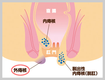 愛宕おしり研究会 おしりの病気