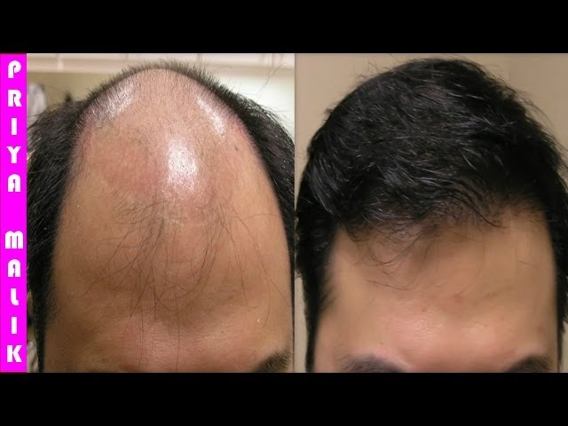Onion Juice For Hair Regrowth Before And After Onion Hair Oil
