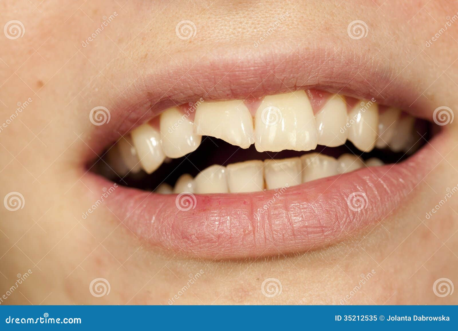 Broken Tooth Royalty Free Stock Photo - Image: 35212535