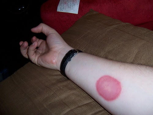 second degree burn. Second Degree Burn