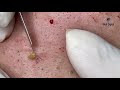 The Oldest Blackhead Ever!