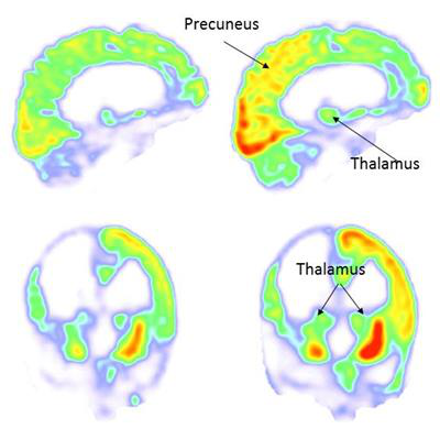 2017_09_25_16_39_6113_PET_pre_post_VNS_M