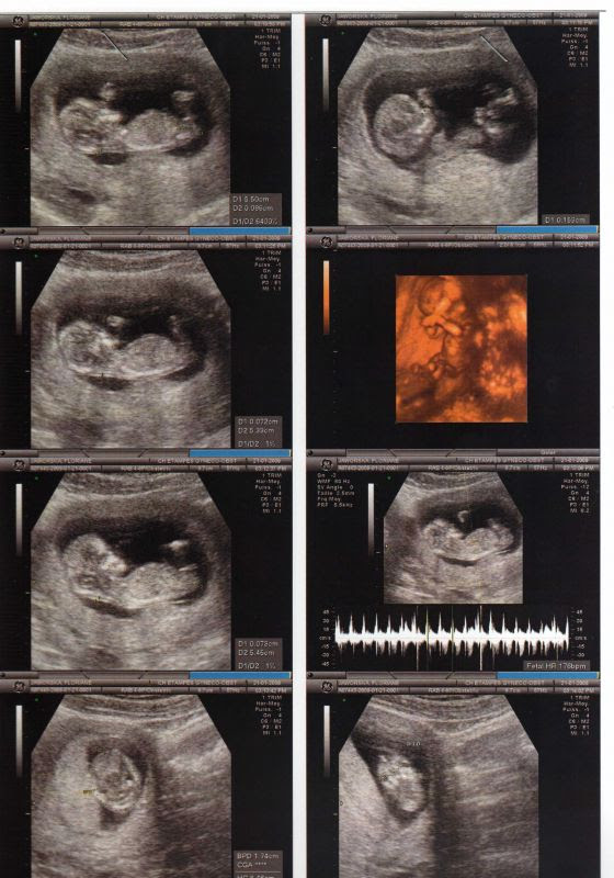 Premiere Echographie Officielle Bebe 11 Semaine 6jours Florianne Et Jerome Accouchement Prevu Le 14 Aout 09