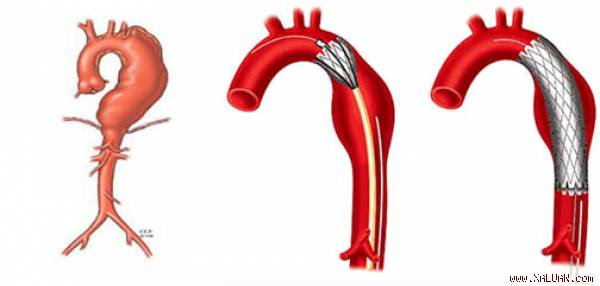 Phình động mạch chủ ngực. Đặt stent - graft trong phình động mạch chủ ngực.