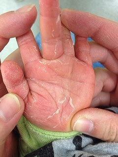 皮膚に白い皮むけ 野田市 小児科 千葉県 こどもの花粉症 こどもの漢方 喘息 アトピー性皮膚炎 アレルギー 結節性痒疹 たんぽぽこどもクリニック
