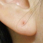 ピアスの穴 ２ 金属アレルギーからの復活 お鍋を探せ 楽天ブログ