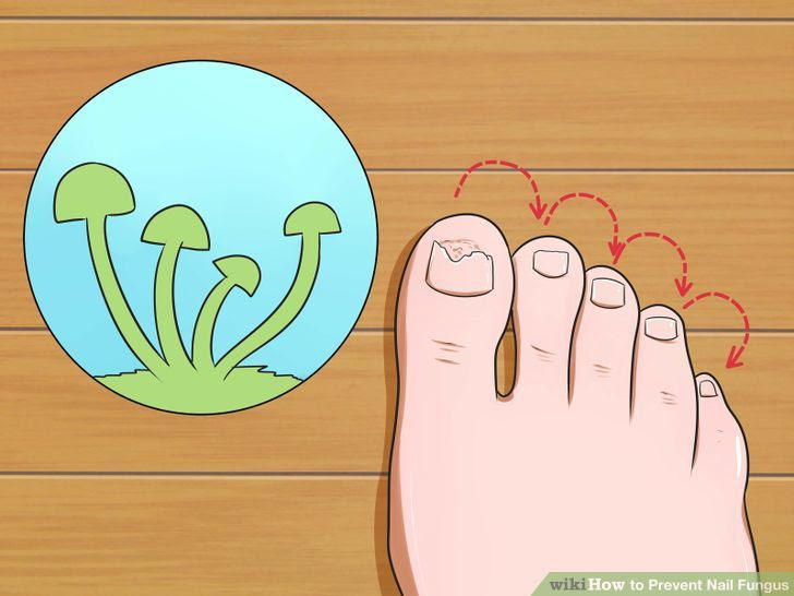 Prevent Nail Fungus Step 4.jpg