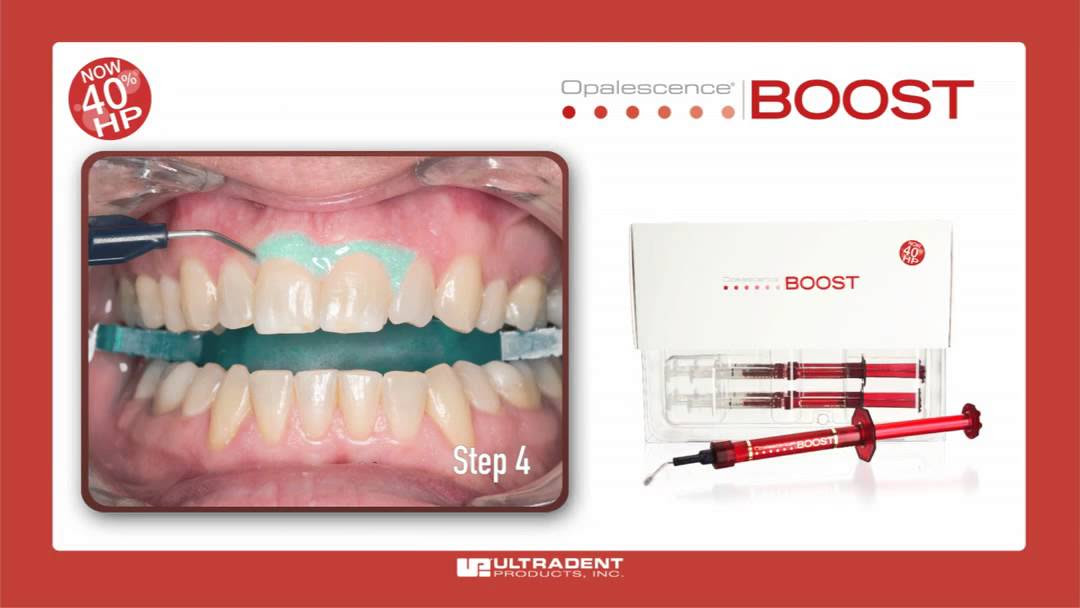 In office tooth whitening