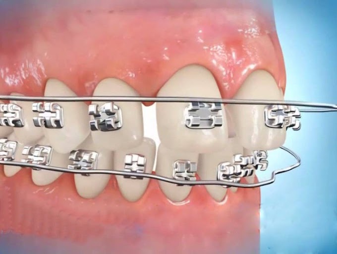 Mắc cài niềng răng bị bung - Nguyên nhân và cách khắc phục