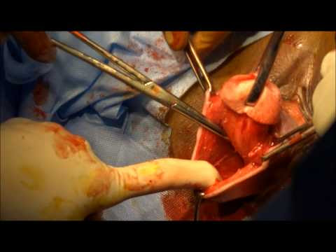 Vaginal and Uterine Prolapse