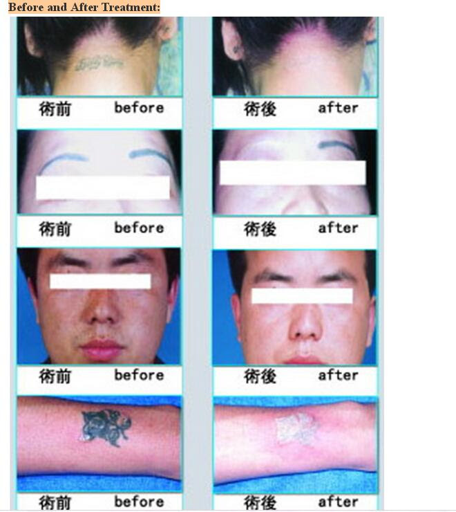 China Q-Switched ND: YAG Laser Tattoo-Removal System ...