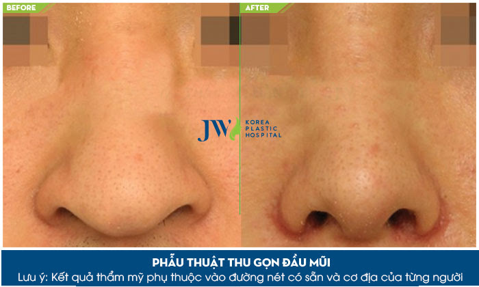 Phẫu thuật thẩm mỹ thu nhỏ đầu mũi