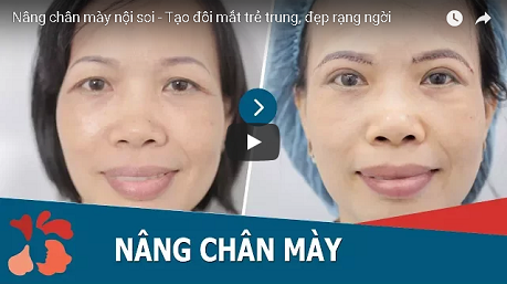 Treo chân mày bao nhiêu tiền 9846513
