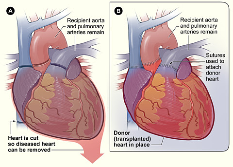 damaged heart. Slim and damaged heart