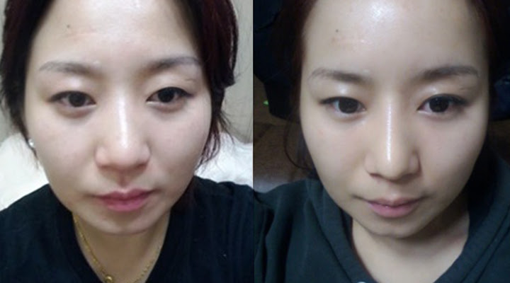 Hà Phương trước khi bấm mí mắt Hàn Quốc