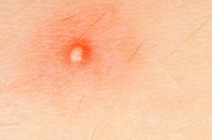 Skin Cancer On Scalp And Headaches : Home Remedies for Boils | ThriftyFun / Helen massy, bsc, is a freelance medical and health writer with over a decade of experience.