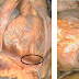 Myocarditis Vs Pericarditis : Infection and inflammation of heart includes endocarditis ... - Pericarditis is a heart condition in which the pericardium (the sac around your heart) is inflamed.