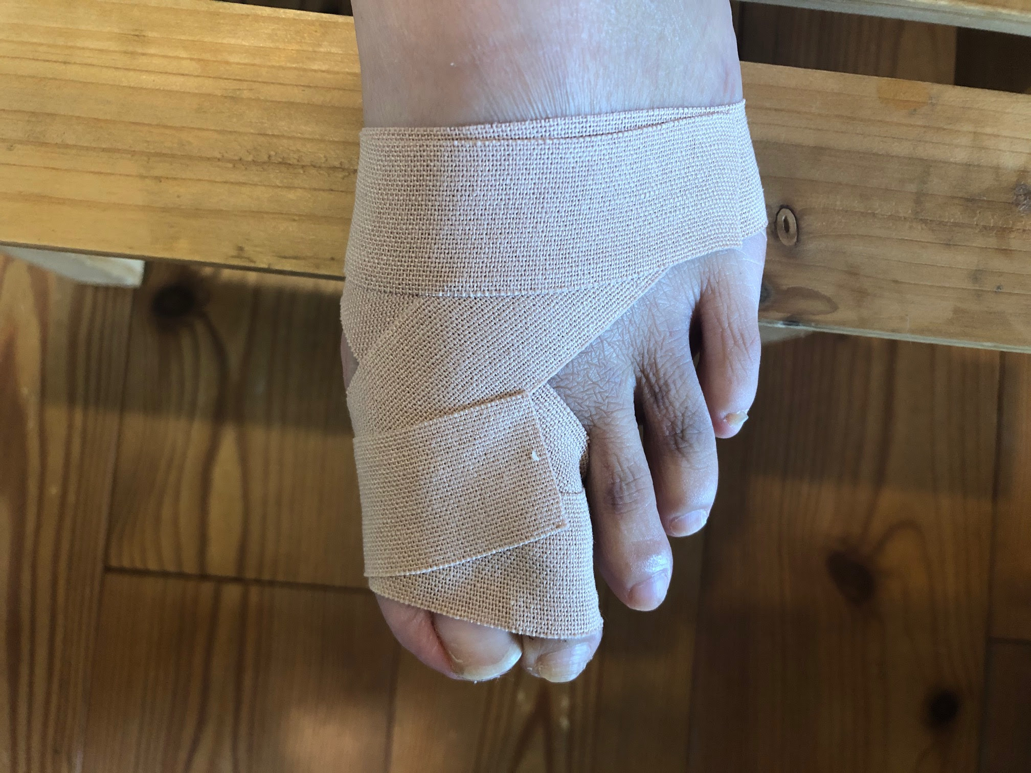 足の指をぶつけて痛い 内出血している 足の指の骨は折れやすい 放っておかずに早目に治療しましょう すみだ整骨院 直方 飯塚 田川 八幡で整骨院なら