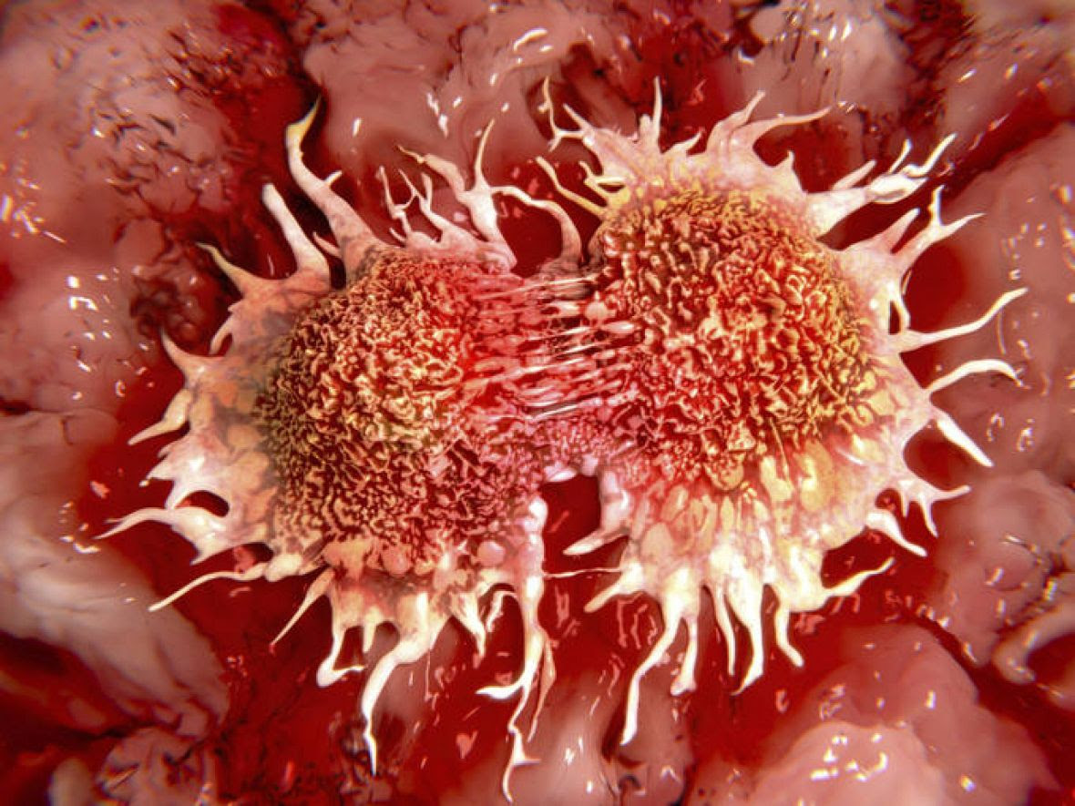 Resultado de imagen de cancer metastasis