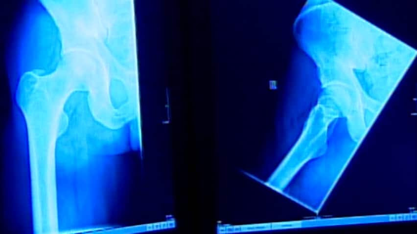 hi-xrays-hips-nl-file