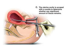 Suction Abortion Illustration - 03