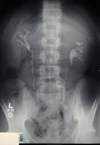 What is a Kidney Xray? | Two Views
