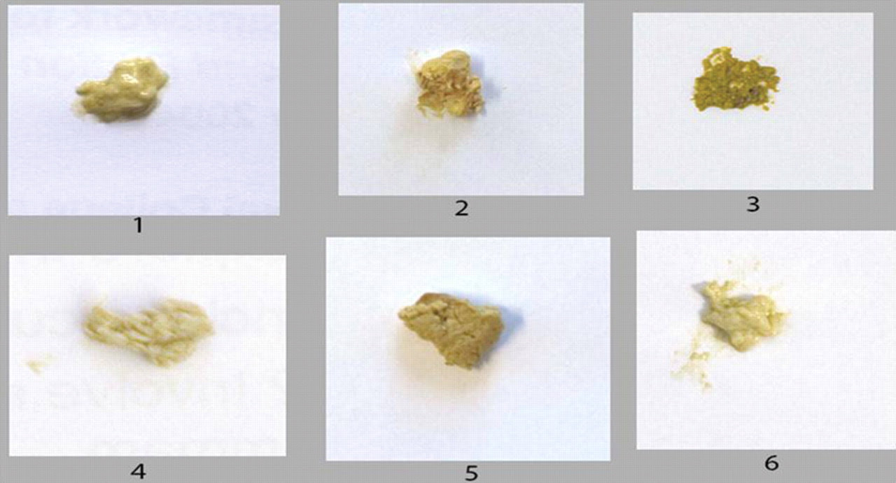 Pancreas: Yellow Stool Pancreas