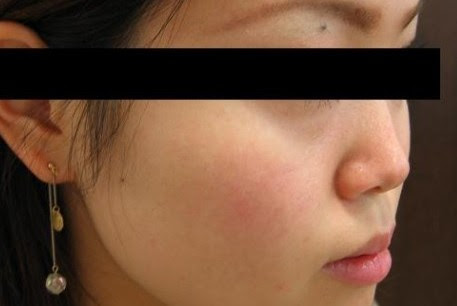 世田谷のしみ治療ならヤスダクリニックまで 専門医による治療