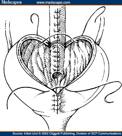Stoma on New Innovations In Continent Catheterizable Stomas  Mitrofanoff