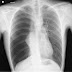 Pneumothorax, Kondisi Ketika Udara Terkumpul Di Rongga Pleura