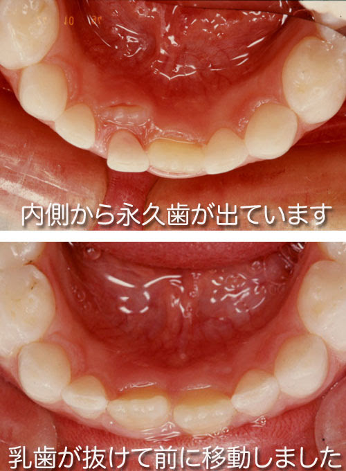 お母さんの歯並び教室