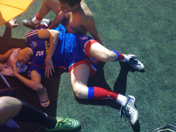 fratura tibia e fibula Fratura Tíbia e Fíbula   1 ano de recuperação
