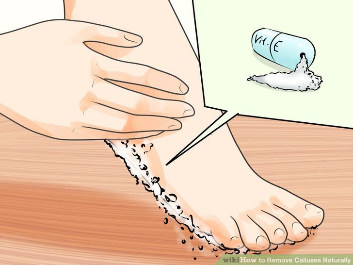 Remove Calluses Naturally Step 6 Version 2.jpg