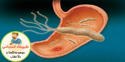 وصفة كاملة وفعالة لعلاج جرثومة المعدة اسامة حجازى 
