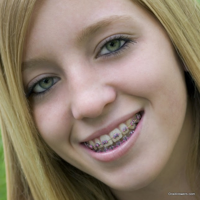 braces_pink_bands_blond_hair_green_eyes