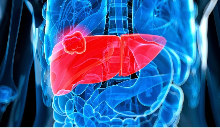 Tumore Al Fegato Fattori Di Rischio Sintomi Diagnosi