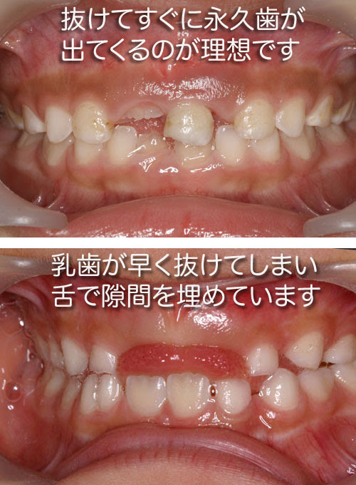 お母さんの歯並び教室