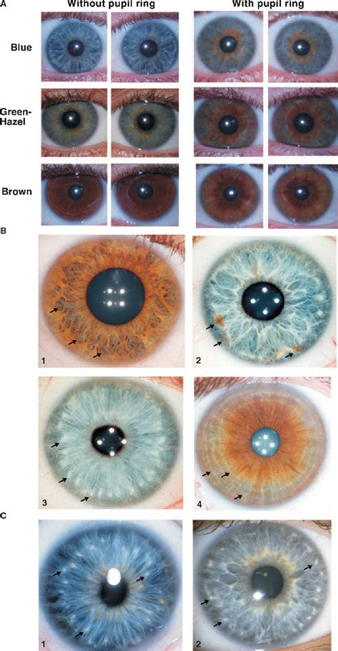 Genes mutate to give alternative forms called alleles, and each . figure 2 from genetics of human iris colour and patterns semantic