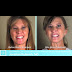 Bell's Palsy Before And After / Facial Nerve Electrodiagnostics For Patients With Facial Palsy A Clinical Practice Guideline Springerlink - This often results in a facial.