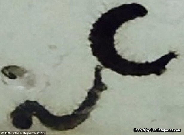 BMJ Case Reports parasite.jpg