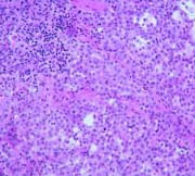 Malignant Mesothelioma Stages