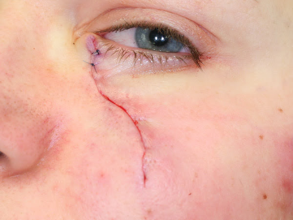 Osterreichische Gesellschaft Fur Dermatochirurgie Ogdc