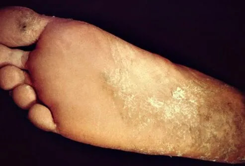 poison ivy rash pictures. poison ivy rash pictures. mild