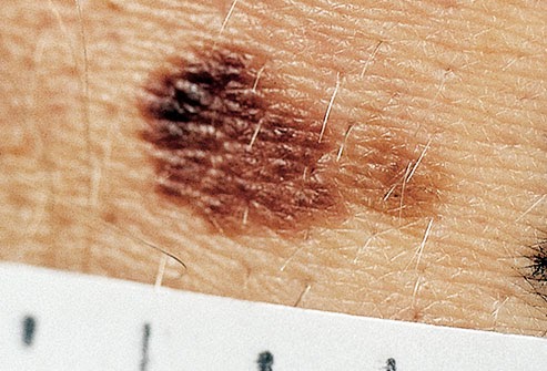 Skin Cancer Freckle - Skin Cancer & Moles | Skin Cancer - YouTube / See your gp as soon as possible if you notice changes in a mole, freckle or patch of skin, particularly if the changes happen over a few weeks or months.