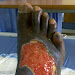 Skin Treatments How To - Scarification As Body Art - XciteFun.netSkin Treatments How To / TropicalMed | Free Full-Text | Mycetoma: The Spectrum of